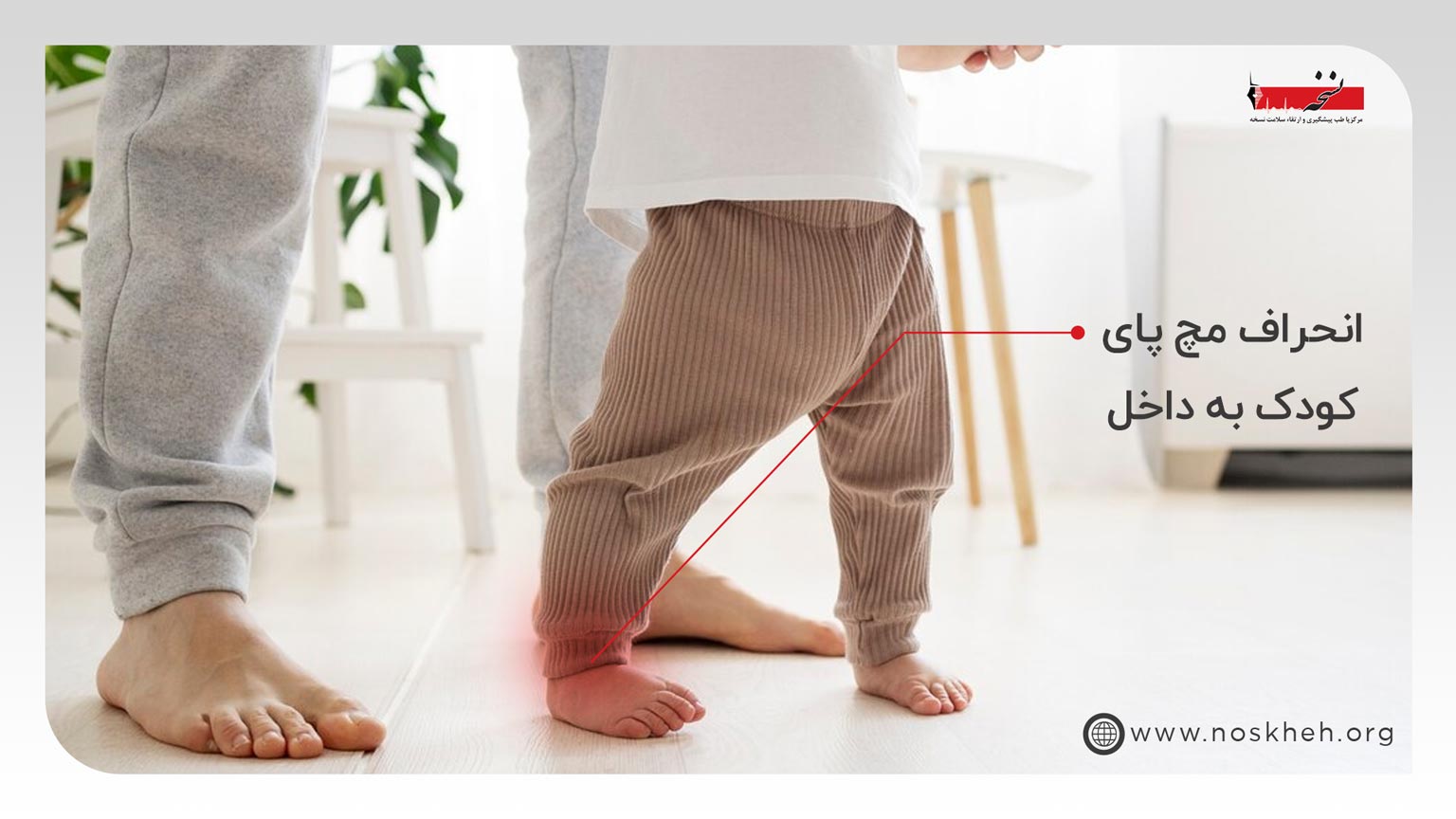 انحراف مچ پای کودک به داخل و خارج-کلینیک نسخه.