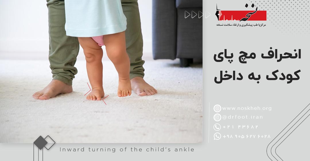 انحراف مچ پای کودک به داخل و خارج-کلینیک نسخه.
