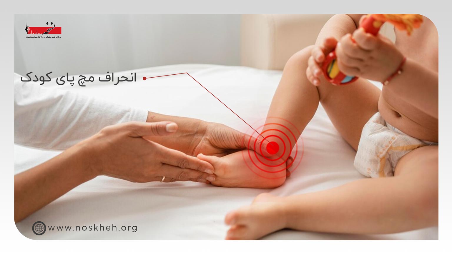 انحراف مچ پای کودک-کلینیک نسخه